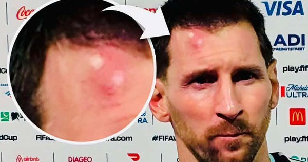 Messi sưng vêu trán sau trận thắng Cabo Verde: Vì sao nên nỗi? - hình ảnh - vipqq88.com